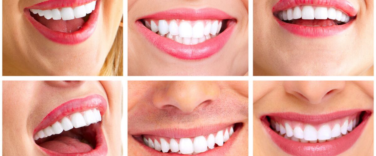 A fogfehérítés egyre elterjedtebb szépészeti beavatkozás